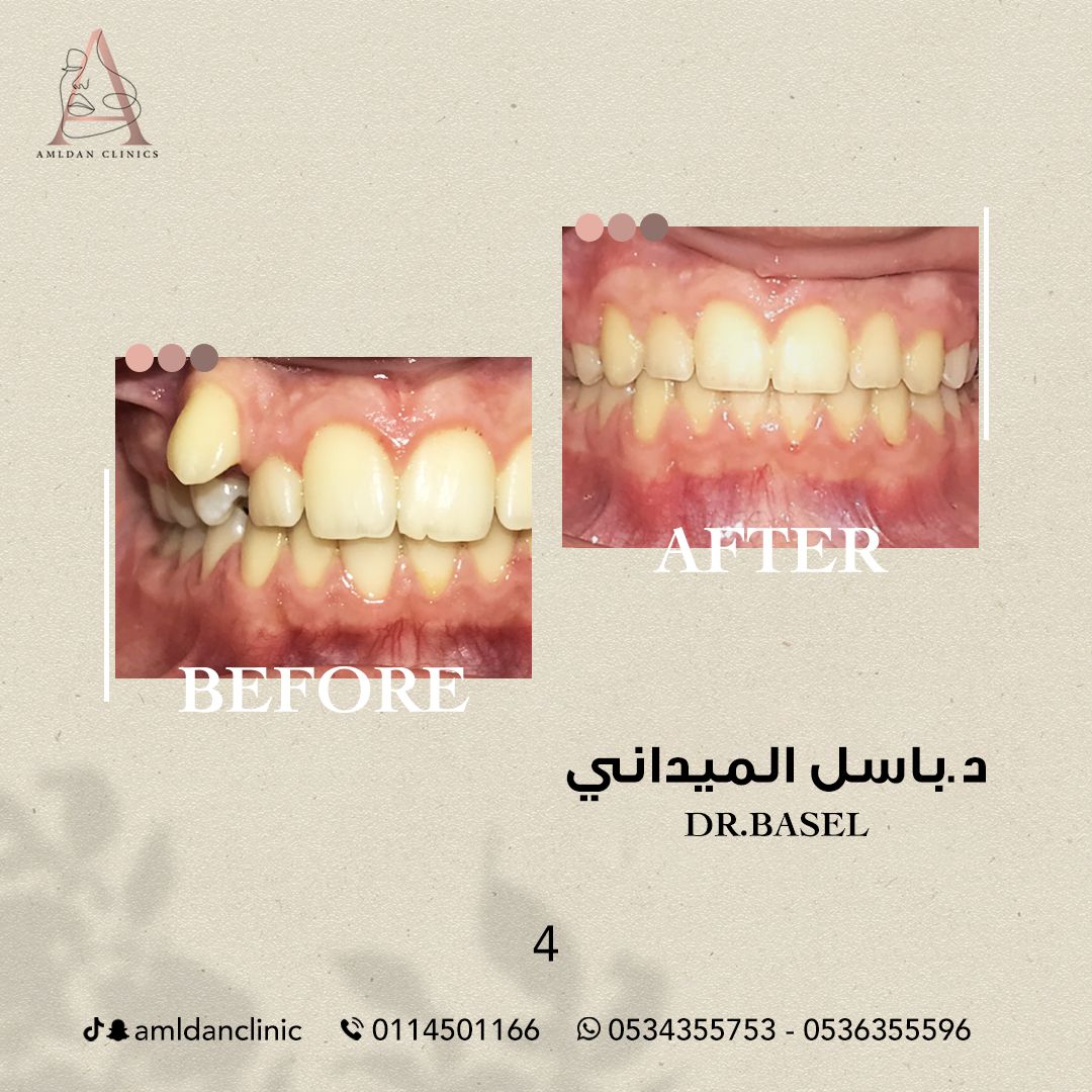 قبل وبعد تقويم الاسنان فى الرياض 