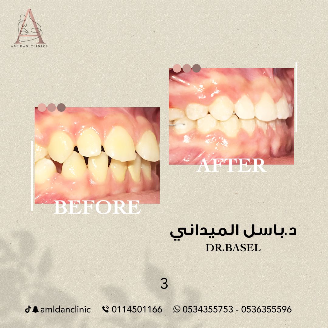 قبل وبعد تقويم الاسنان فى الرياض 