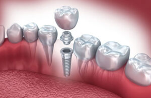 Read more about the article أسعار زراعة الأسنان في الرياض؟