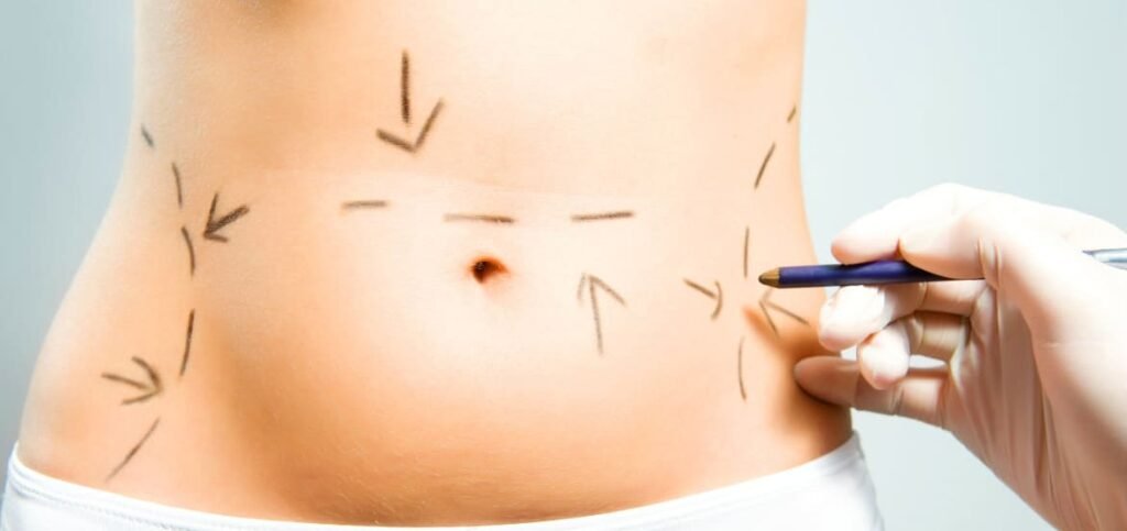 شفط الدهون في الرياض