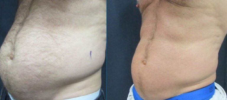 شفط الدهون في الرياض 2025