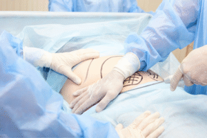 Read more about the article تكلفة شفط دهون البطن في الرياض