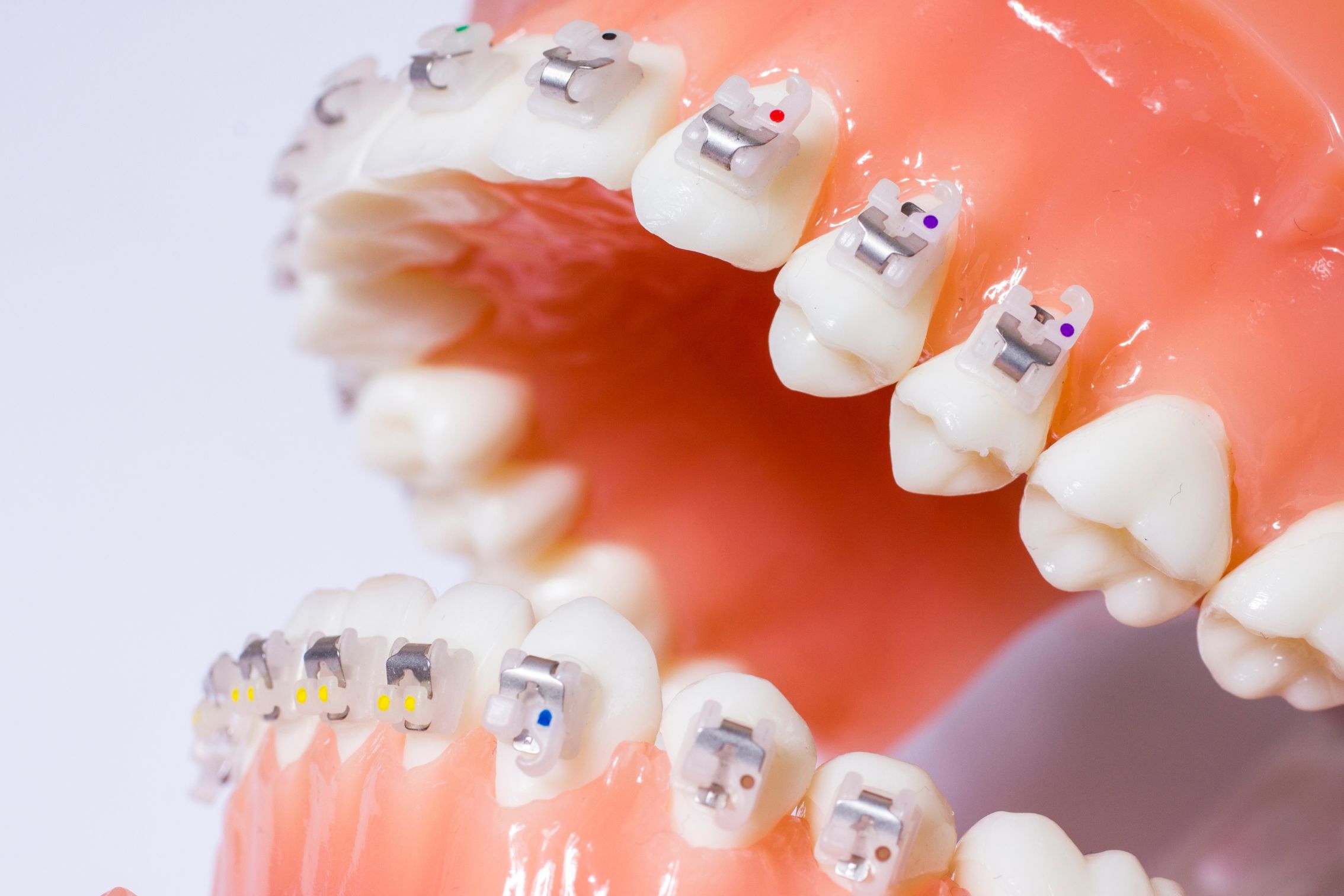 Read more about the article تكلفة تقويم الأسنان في الرياض: دليل شامل من مجمع عيادات أملدان