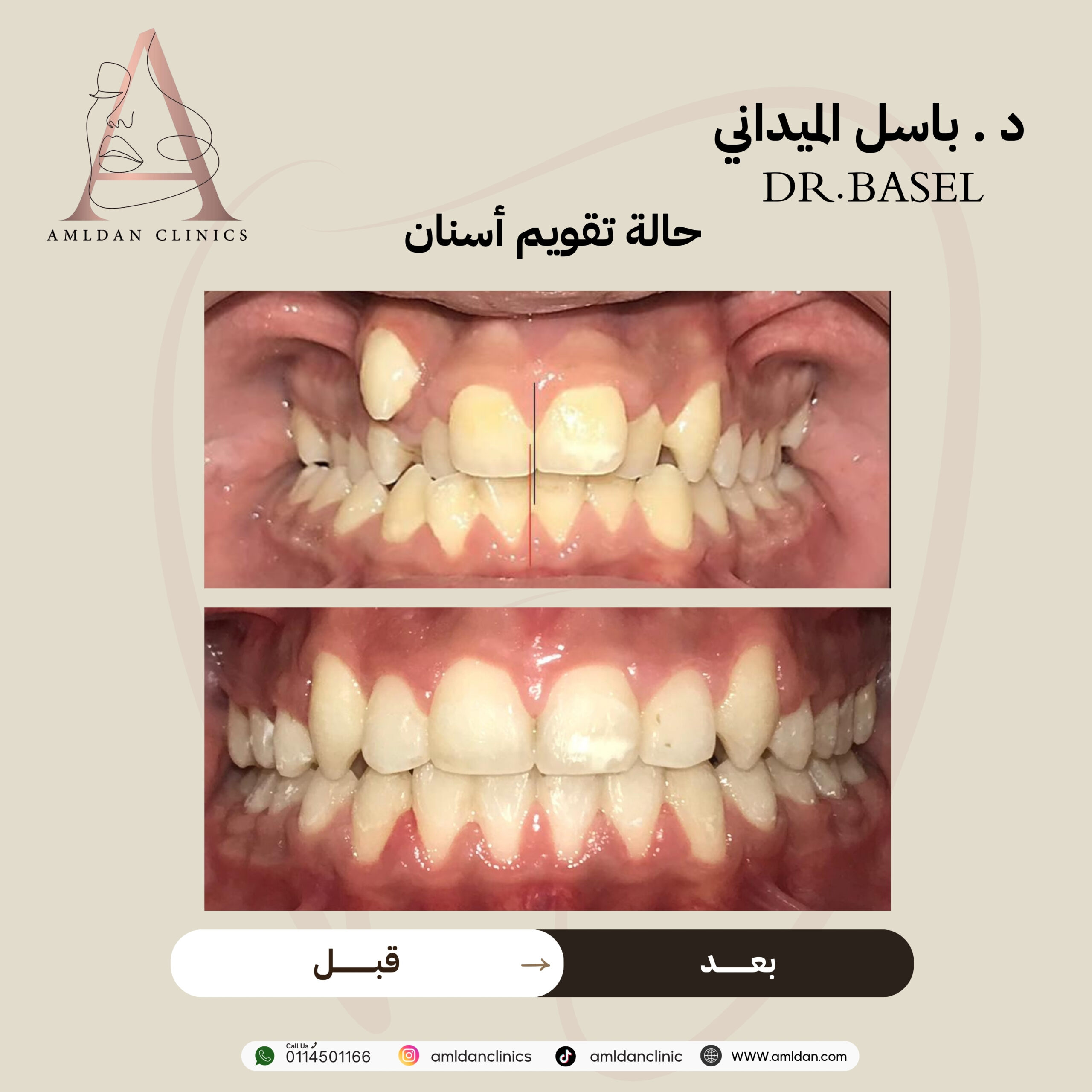 تجربتي مع تقويم الاسنان بالرياض