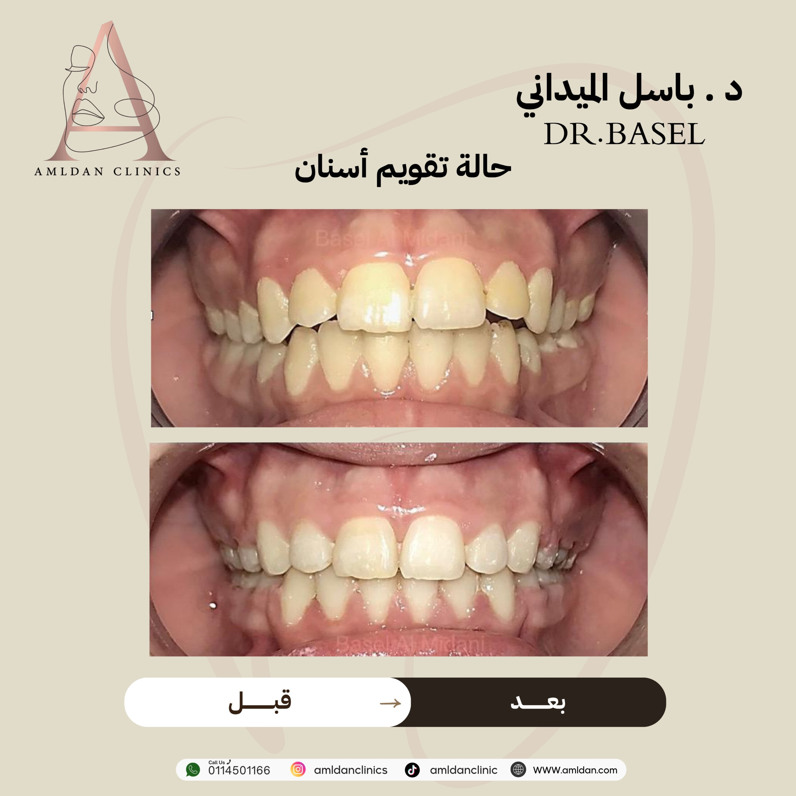 تجربتي مع تقويم الاسنان بالرياض