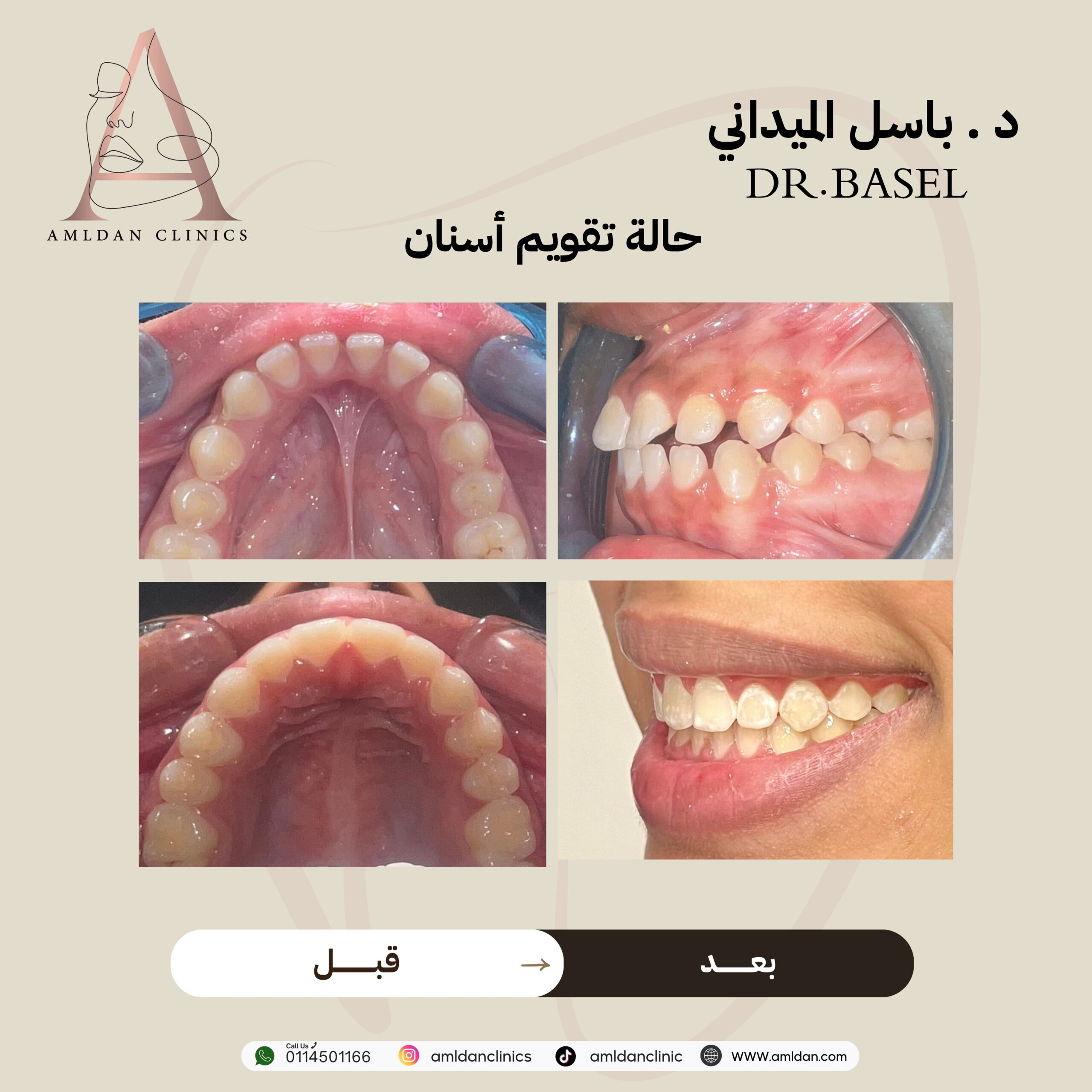 تجربتي مع تقويم الاسنان بالرياض