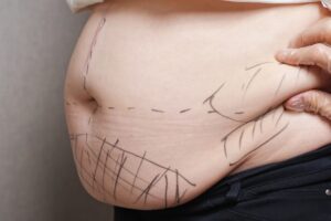 Read more about the article ليش الكل صار يتكلم عن شفط دهون البطن بالرياض؟