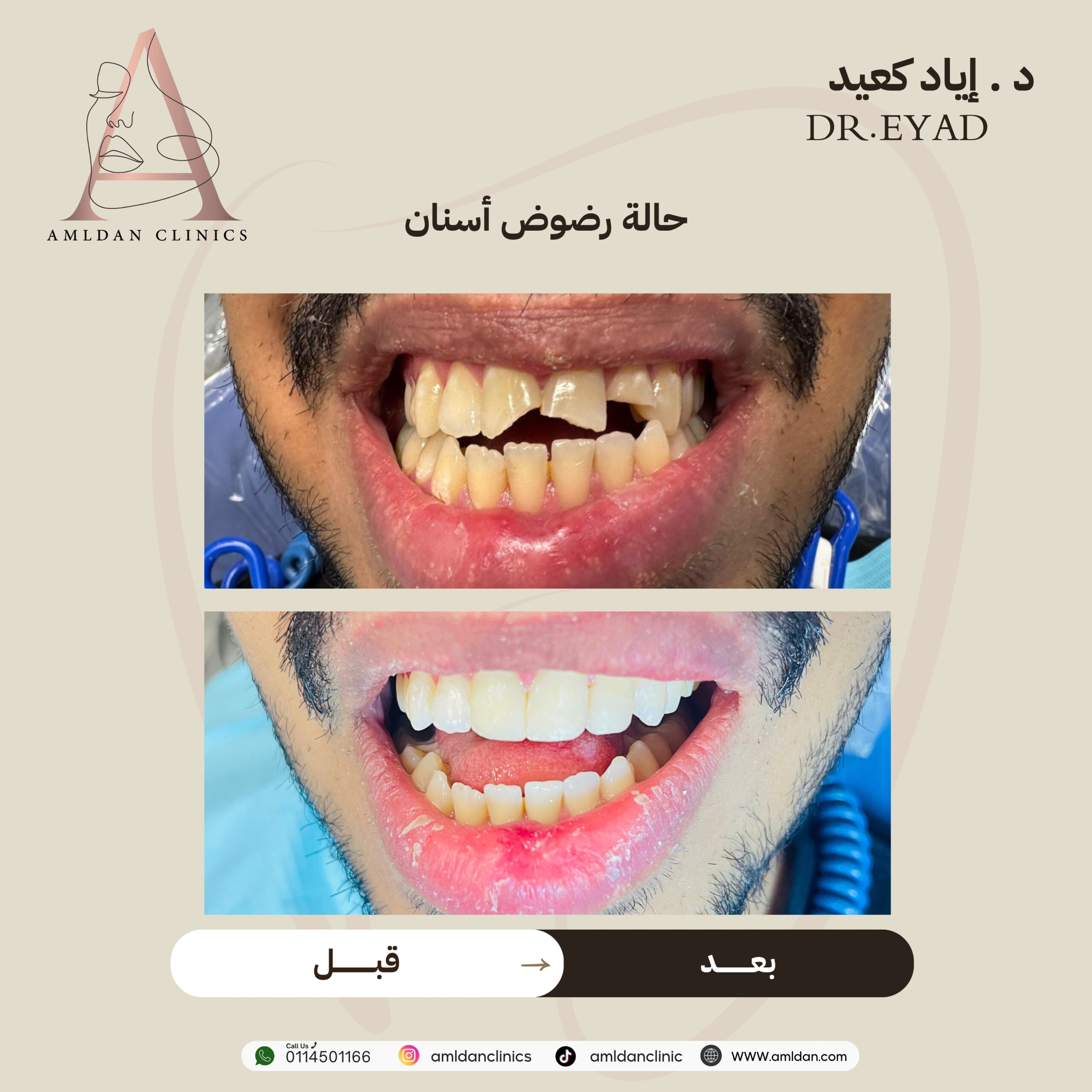 تجربتي مع تركيبات الاسنان بالرياض