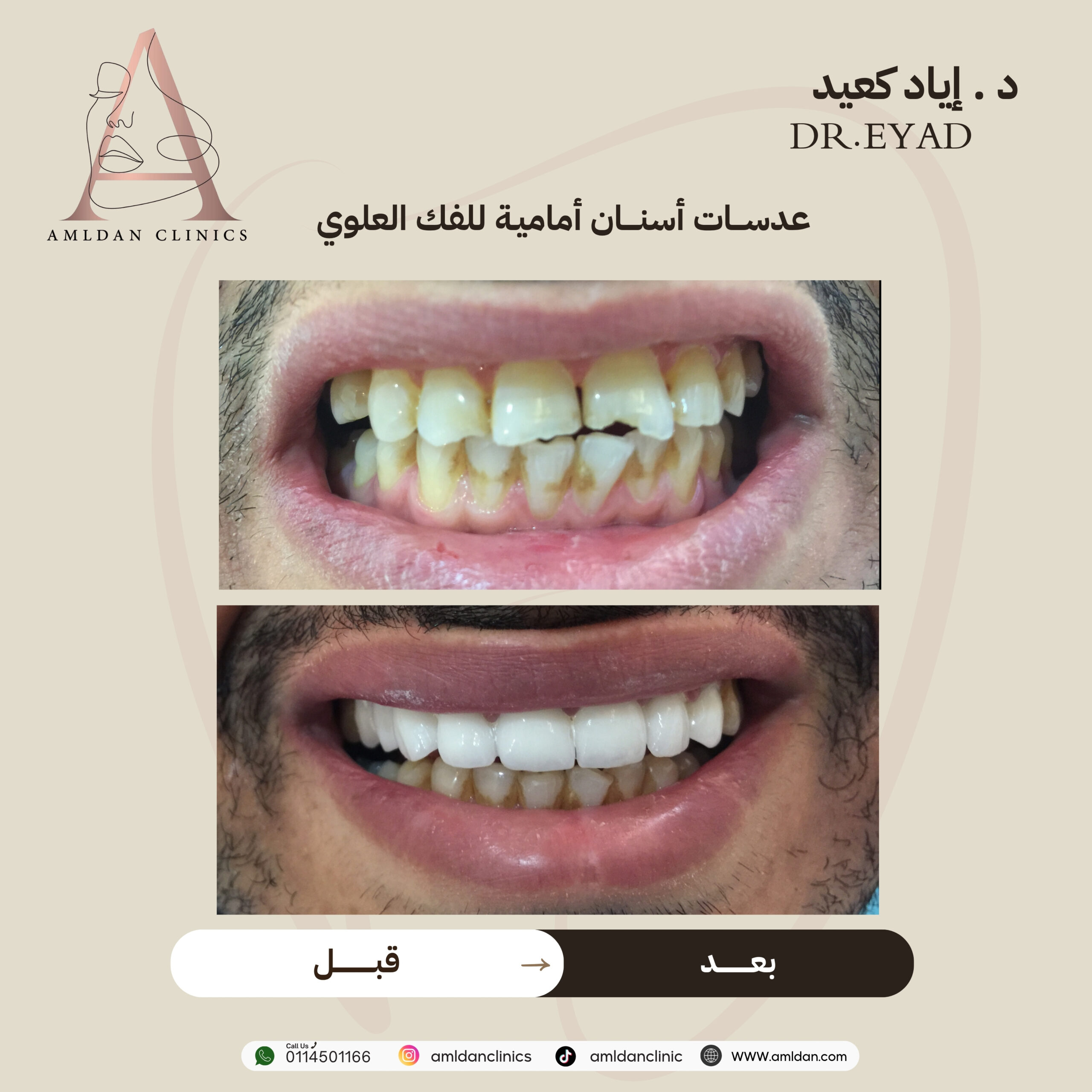تركييبات اسنان بالرياض
