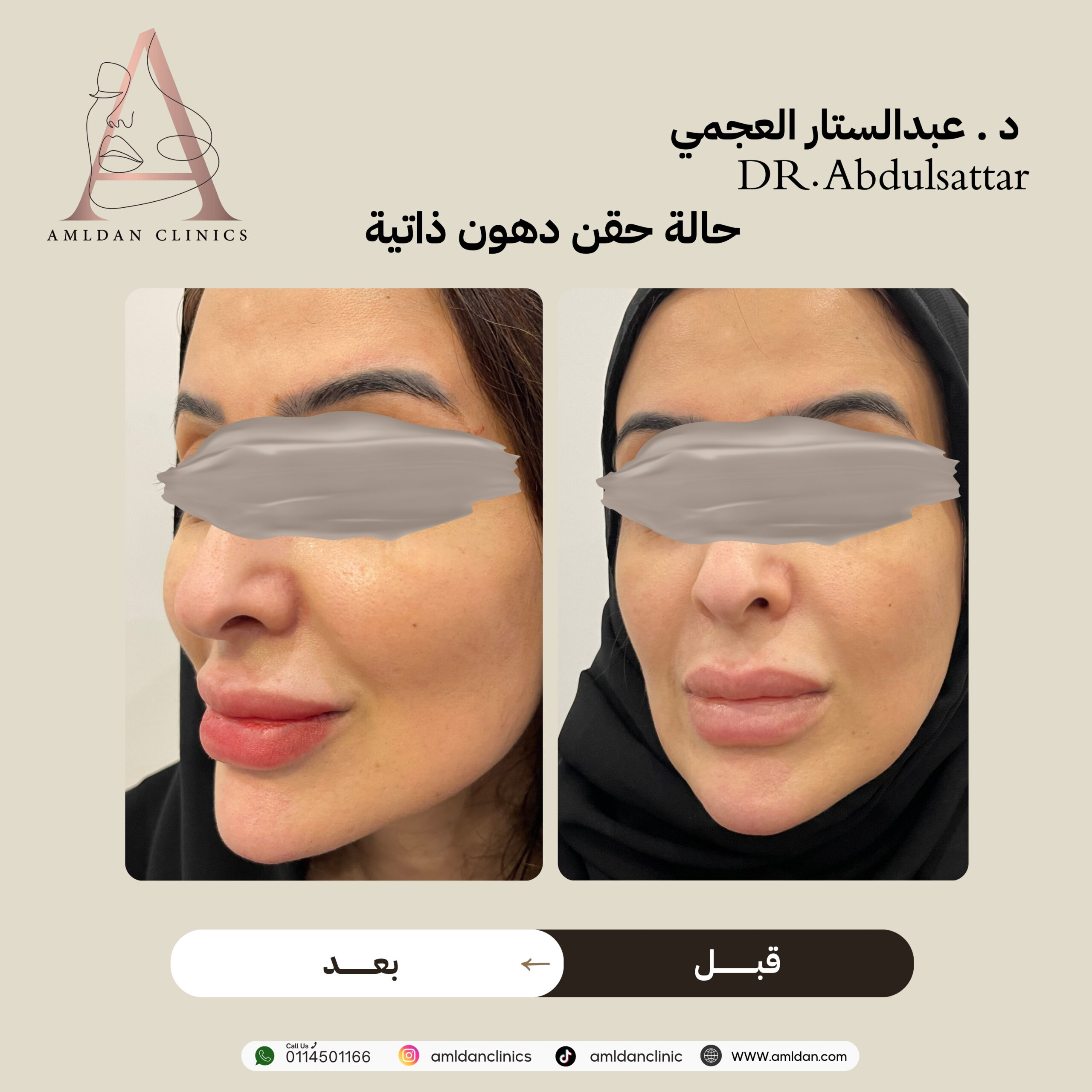 حقن دهون ذاتية بالرياض