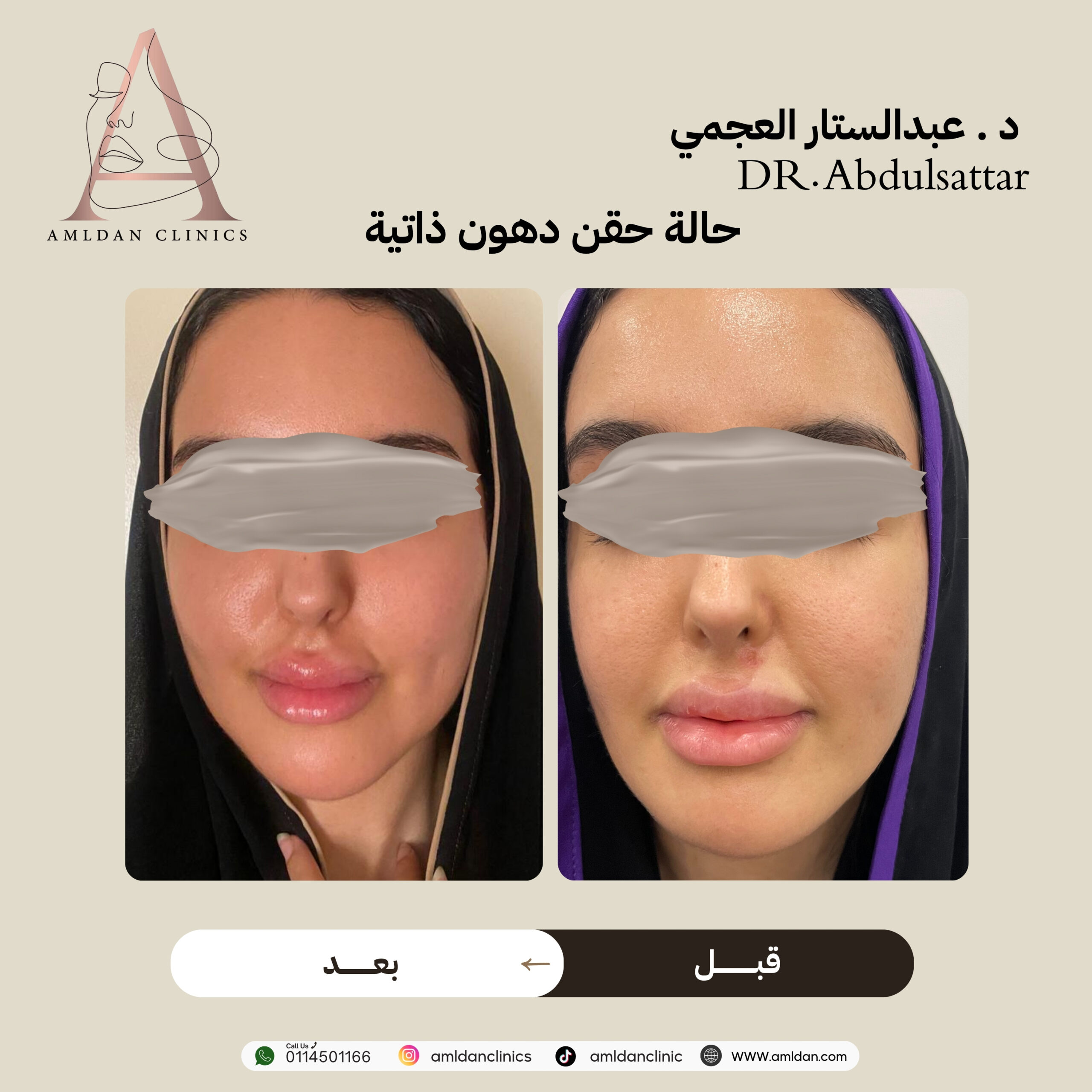 حقن دهون ذاتية بالرياض