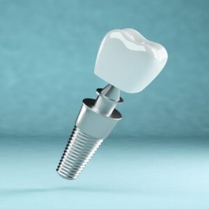 Read more about the article تكلفة زراعة الأسنان في الرياض 2025: دليلك الكامل مع عيادات أملدان