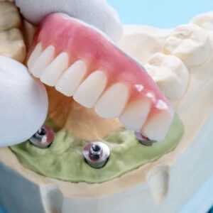 Read more about the article تجربتي مع زراعة الأسنان في الرياض وخطوات العملية من البداية للنهاية