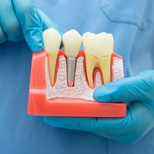 Read more about the article تجربتي مع زراعة الأسنان في الرياض… رحلة بدأت بخوف وانتهت بابتسامة ما تفارق وجهي