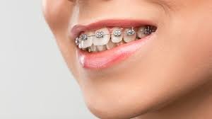 Read more about the article تجربتي مع تقويم الأسنان في الرياض: المدة، النتائج، وخدمة الأقساط في أفضل المراكز