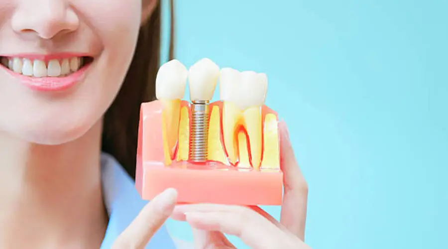 إرشادات وتعليمات بعد زراعة الأسنان