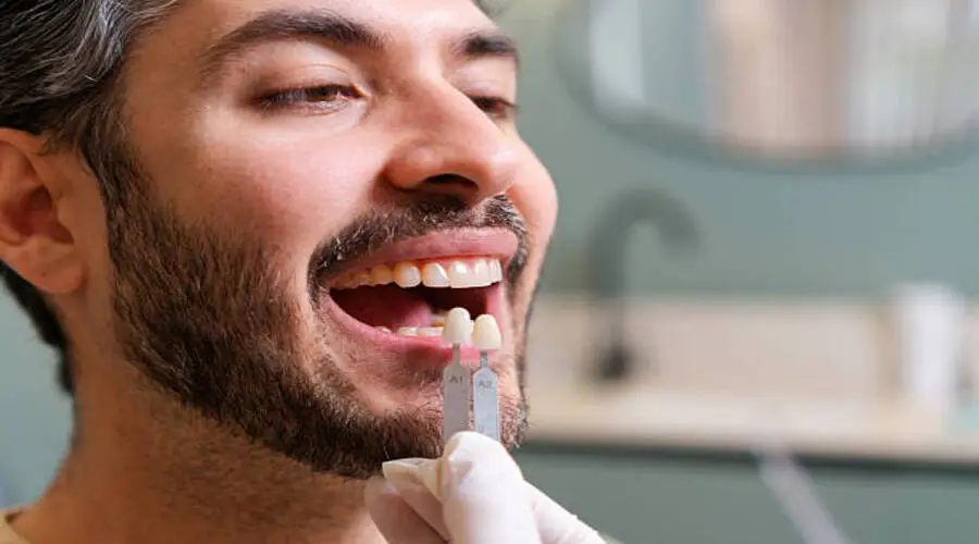 تلبيسة الأسنان 