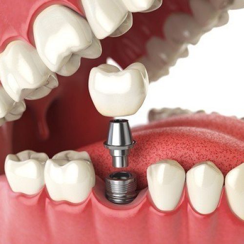 خطوات زراعة الاسنان تكلفة زراعة الأسنان في الرياض