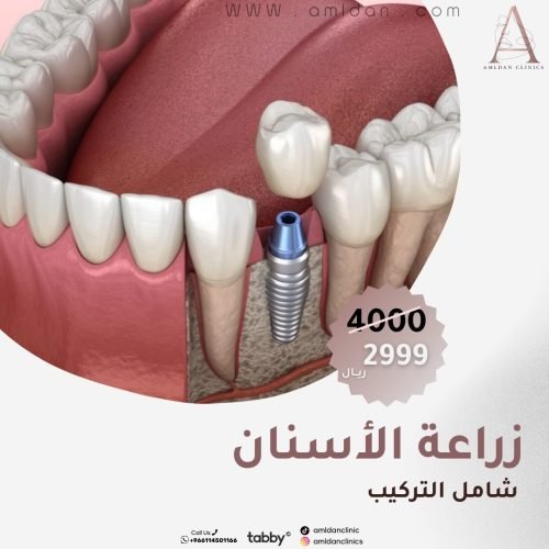 تكلفة زراعة الأسنان في الرياض