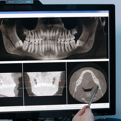 تكلفة زراعة الأسنان في الرياض