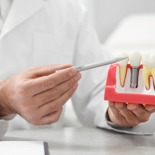 زراعة الأسنان في الرياض